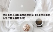 甲沟炎怎么治疗最快最好方法（手上甲沟炎怎么治疗最快最好方法）